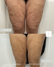 Load image into Gallery viewer, Tighten Sagging Skin Without Surgery — Finally Fix the Neck, Jawline & Arms