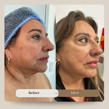 Load image into Gallery viewer, Tighten Sagging Skin Without Surgery — Finally Fix the Neck, Jawline & Arms