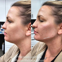 Load image into Gallery viewer, Jawline Filler