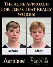 Load image into Gallery viewer, Aerolase Neo Elite®