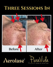 Load image into Gallery viewer, Aerolase Neo Elite®