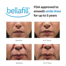 Load image into Gallery viewer, Dermal Fillers