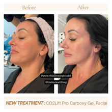 Load image into Gallery viewer, CO₂Lift® Carboxy Gel Mask – 3 Treatment Pack