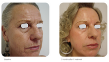 Load image into Gallery viewer, AcuPulse™ CO₂ Laser – Resurface, Renew & Rebuild Your Skin