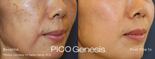 Load image into Gallery viewer, PicoGenesis™ Package – Precision Brightening & Total Skin Renewal