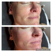 Load image into Gallery viewer, SeruGlow Micro-Channeling Consult