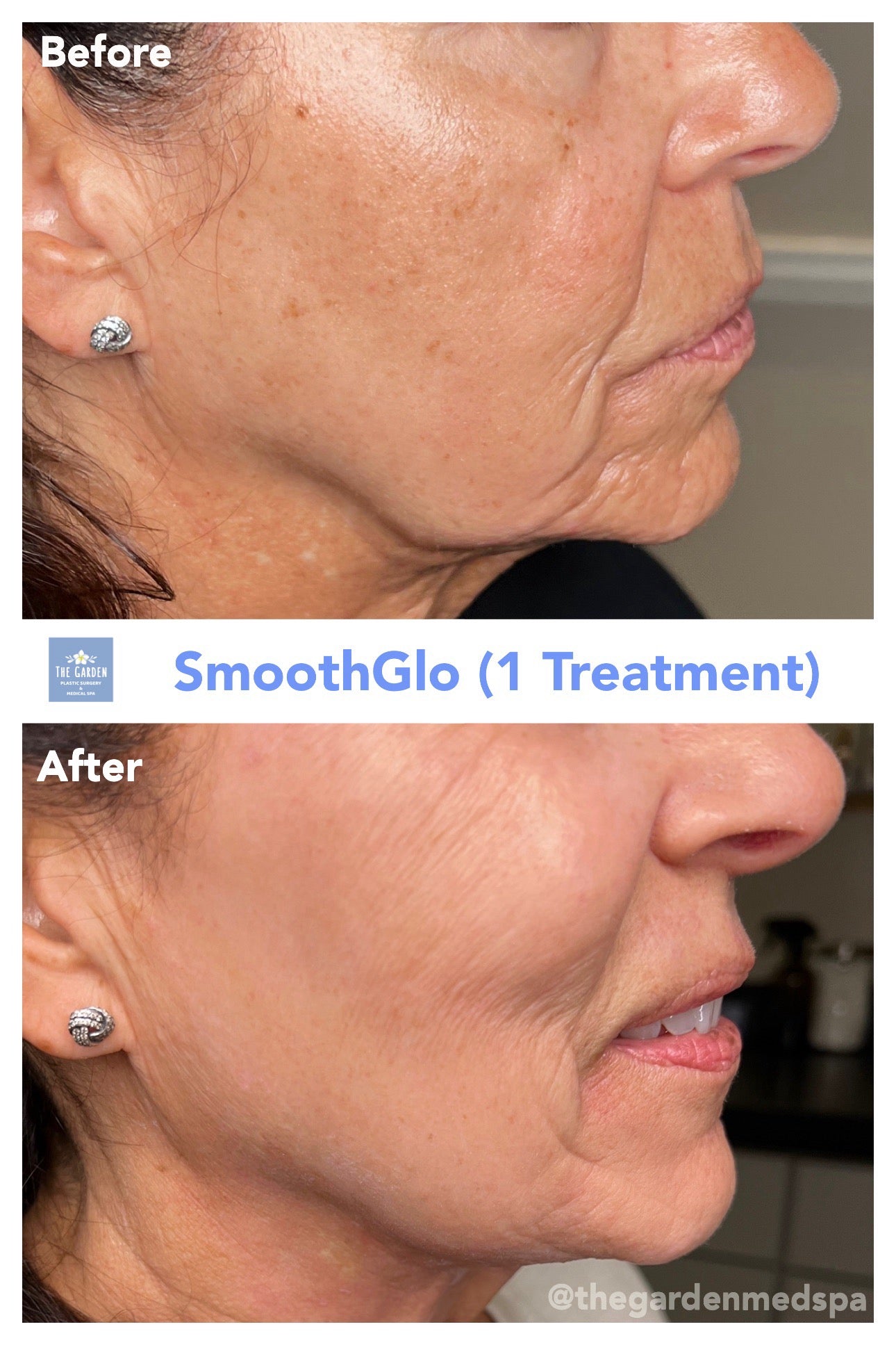 SmoothGlo (IPL Laser + RF Microneedling)