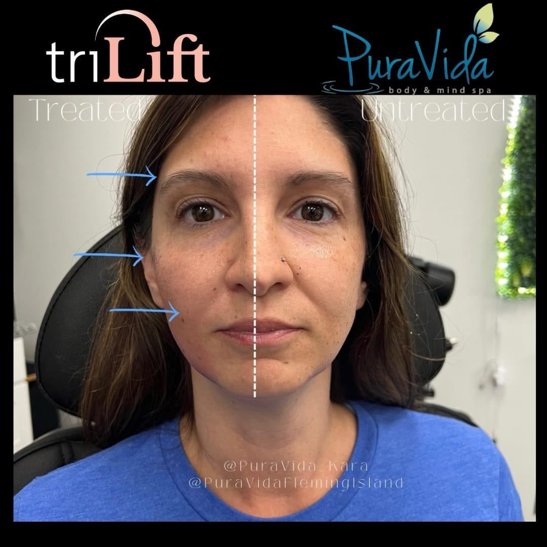 TriLift- Non-Surgical Facelift