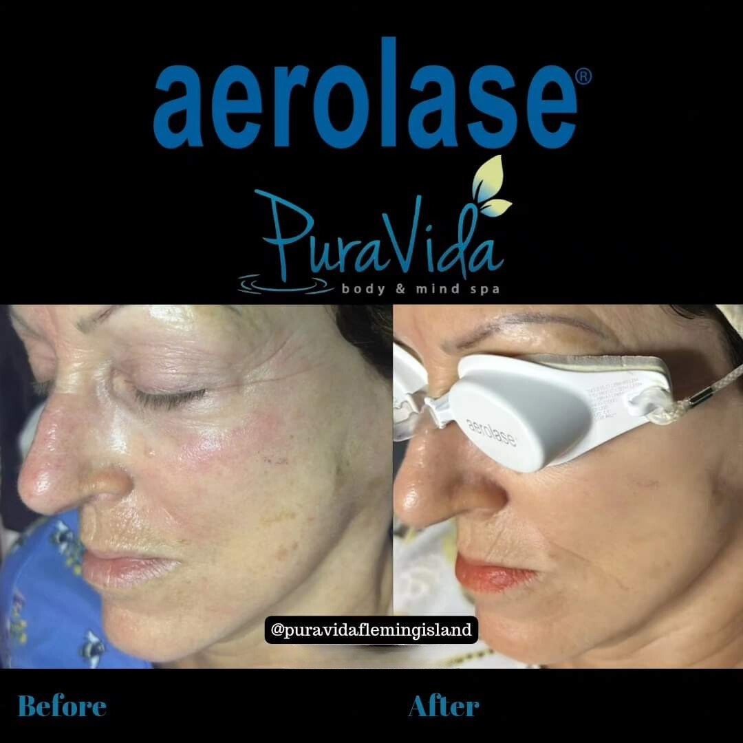 Pigment Package- Peels & Aerolase