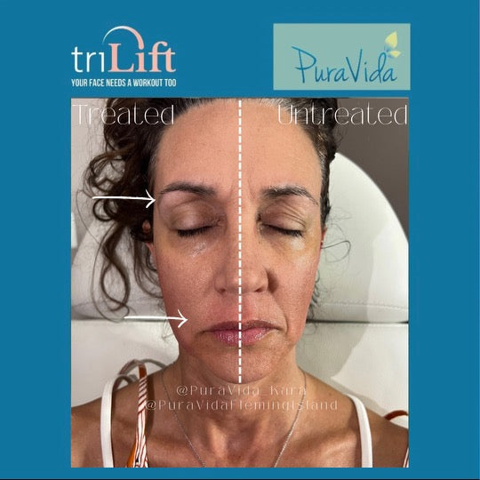 TriLift- RF Microneedling + DMST (dynamic muscle stimulation)