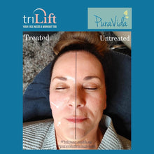 Load image into Gallery viewer, TriLift Non-Surgical Facelift package- 50% OFF
