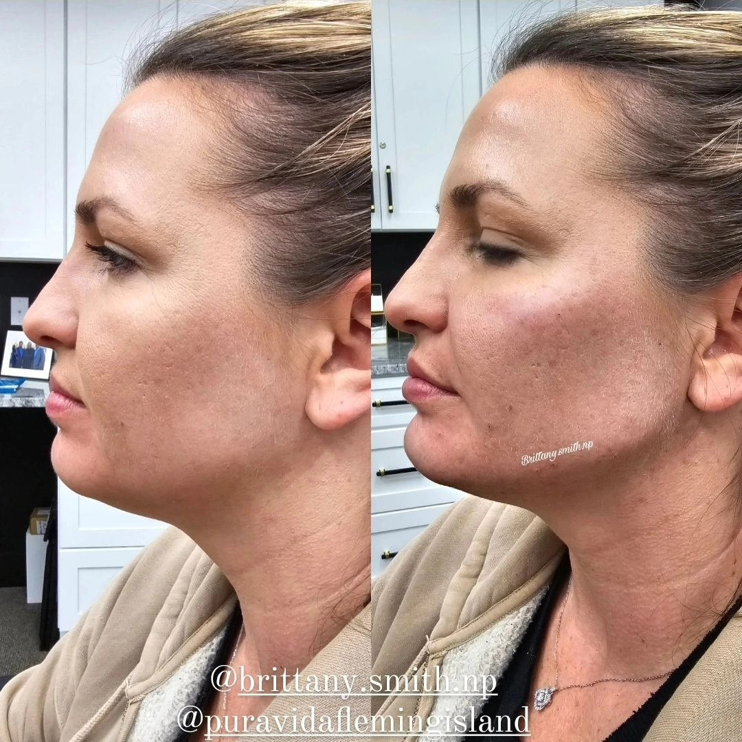 Jawline Filler