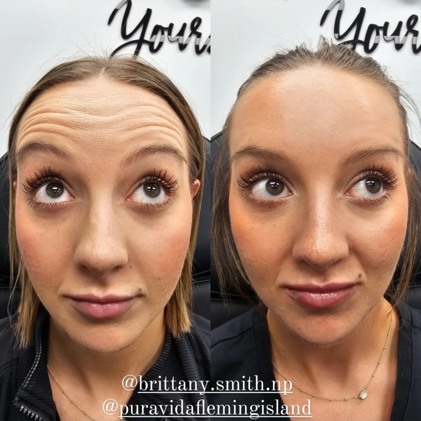 Tox Wrinkle Relaxer