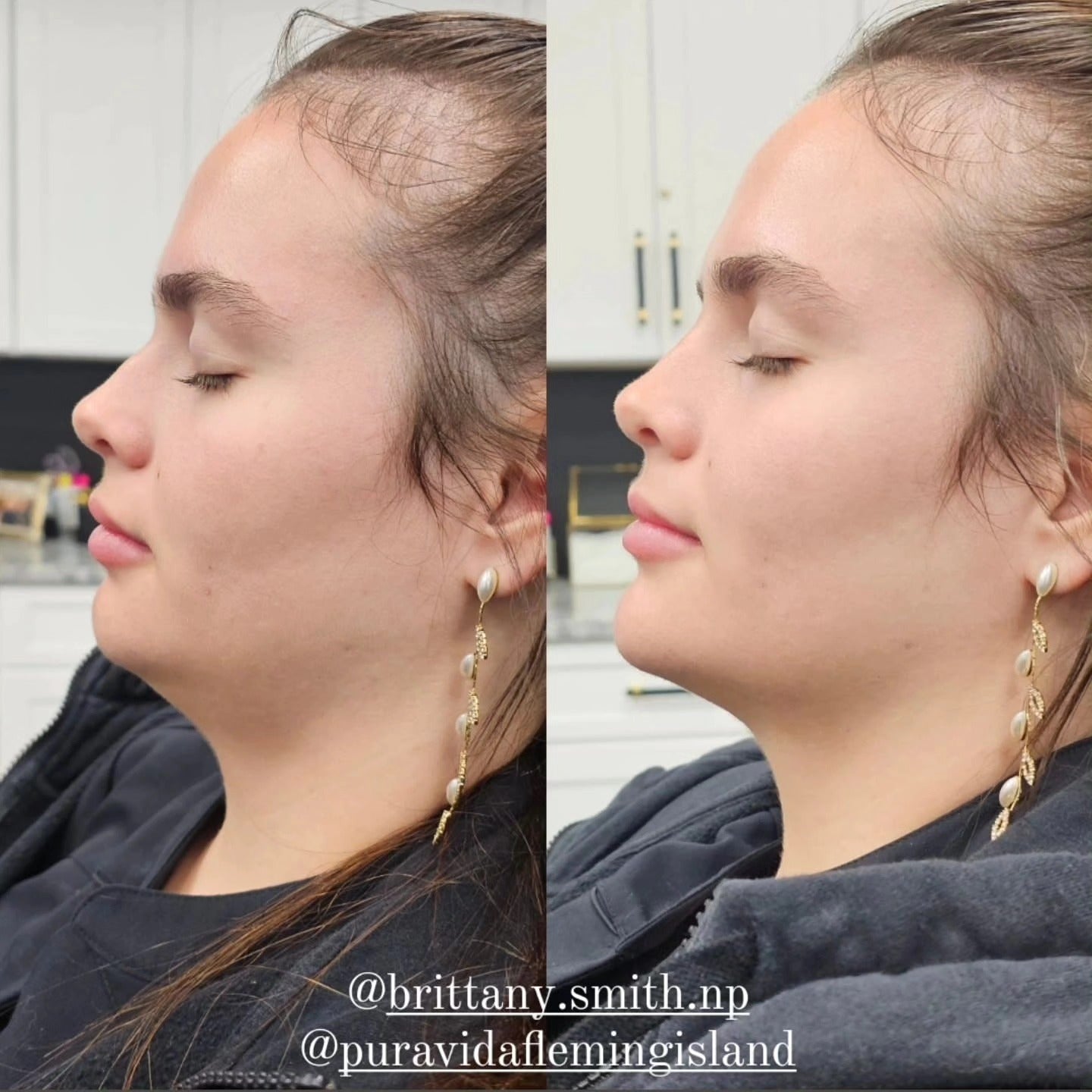 Hyaluronic Acid (HA) Fillers – Restore, Define & Enhance Your Natural Beauty