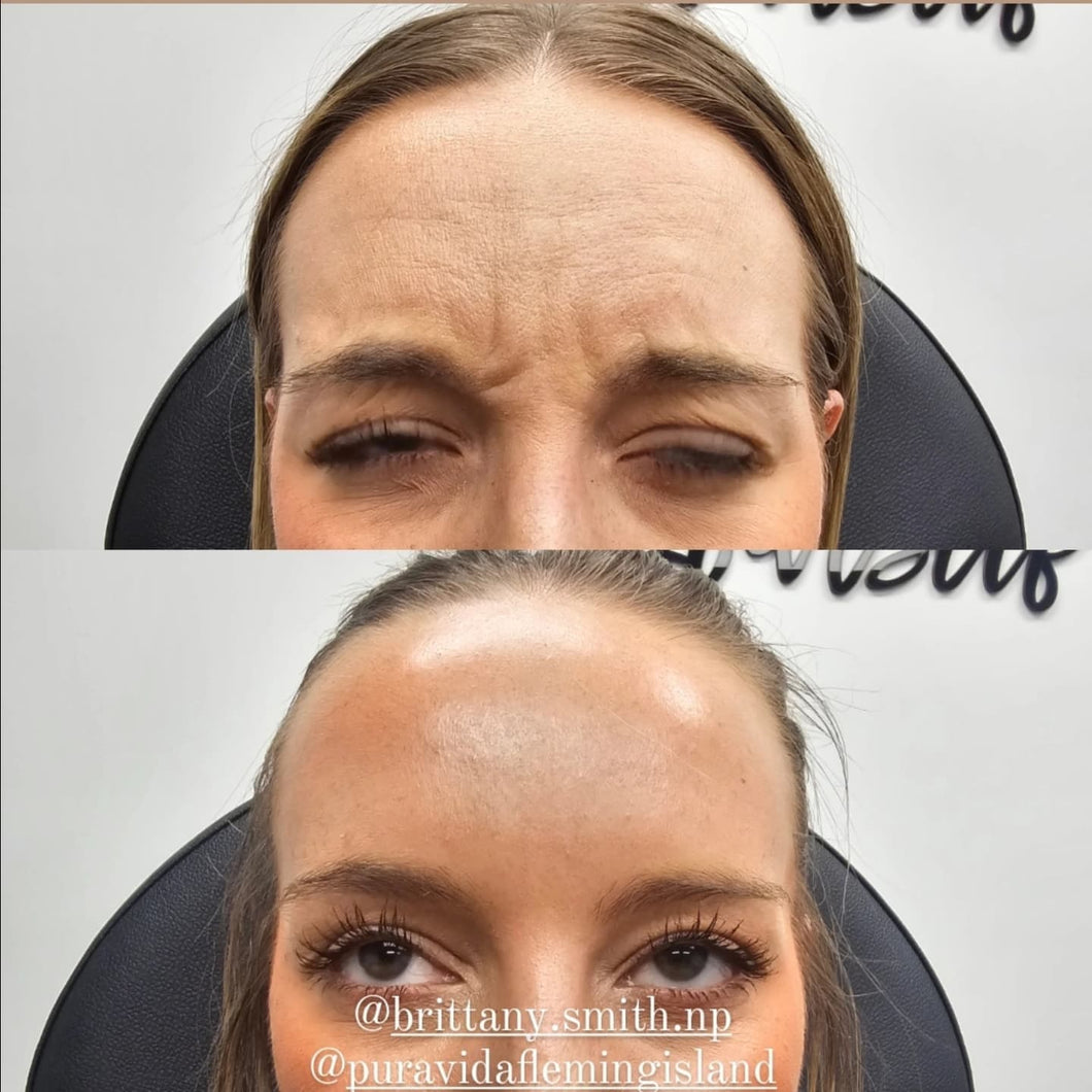 Tox Wrinkle Relaxer