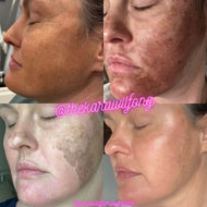 Chemical Peels (VI, ZO, Neova)