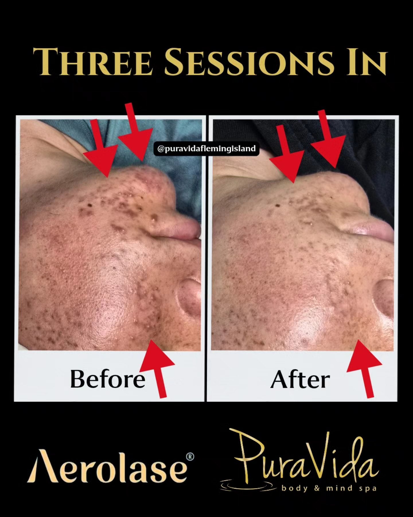 Aerolase Neo Elite®