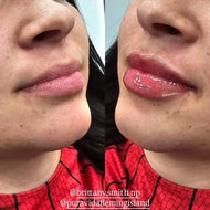 Hyaluronic Acid (HA) Fillers – Restore, Define & Enhance Your Natural Beauty