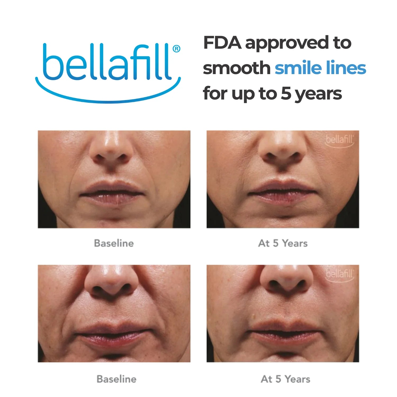Dermal Fillers