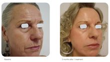 Load image into Gallery viewer, Laser Skin Rejuvenation (Acupulse, IPL, and Aerolase)
