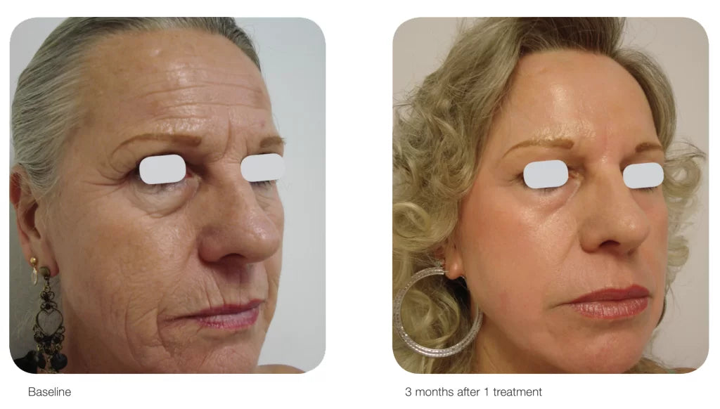 Laser Skin Rejuvenation (Acupulse, IPL, and Aerolase)