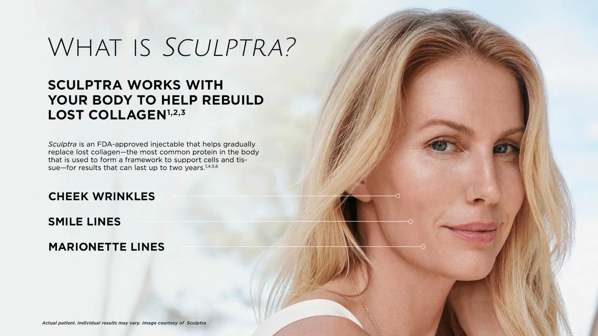 Sculptra Liquid Facelift