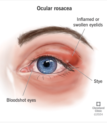 OptiLight- Dry Eye Treatment- Package of 5