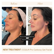 Load image into Gallery viewer, Carboxy Gel Facial
