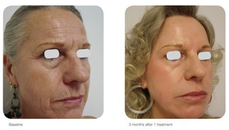 AcuPulse CO2 Resurfacing Laser Treatment