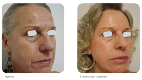 AcuPulse™ CO₂ Laser – Resurface, Renew & Rebuild Your Skin
