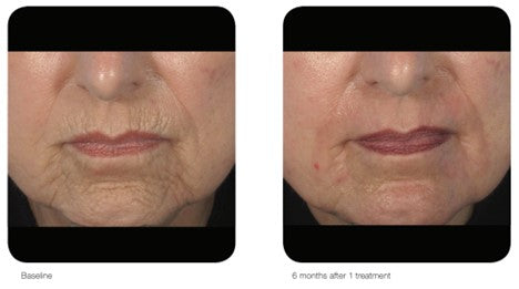 AcuPulse CO2 Resurfacing Laser Treatment