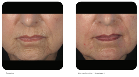 AcuPulse™ CO₂ Laser – Resurface, Renew & Rebuild Your Skin