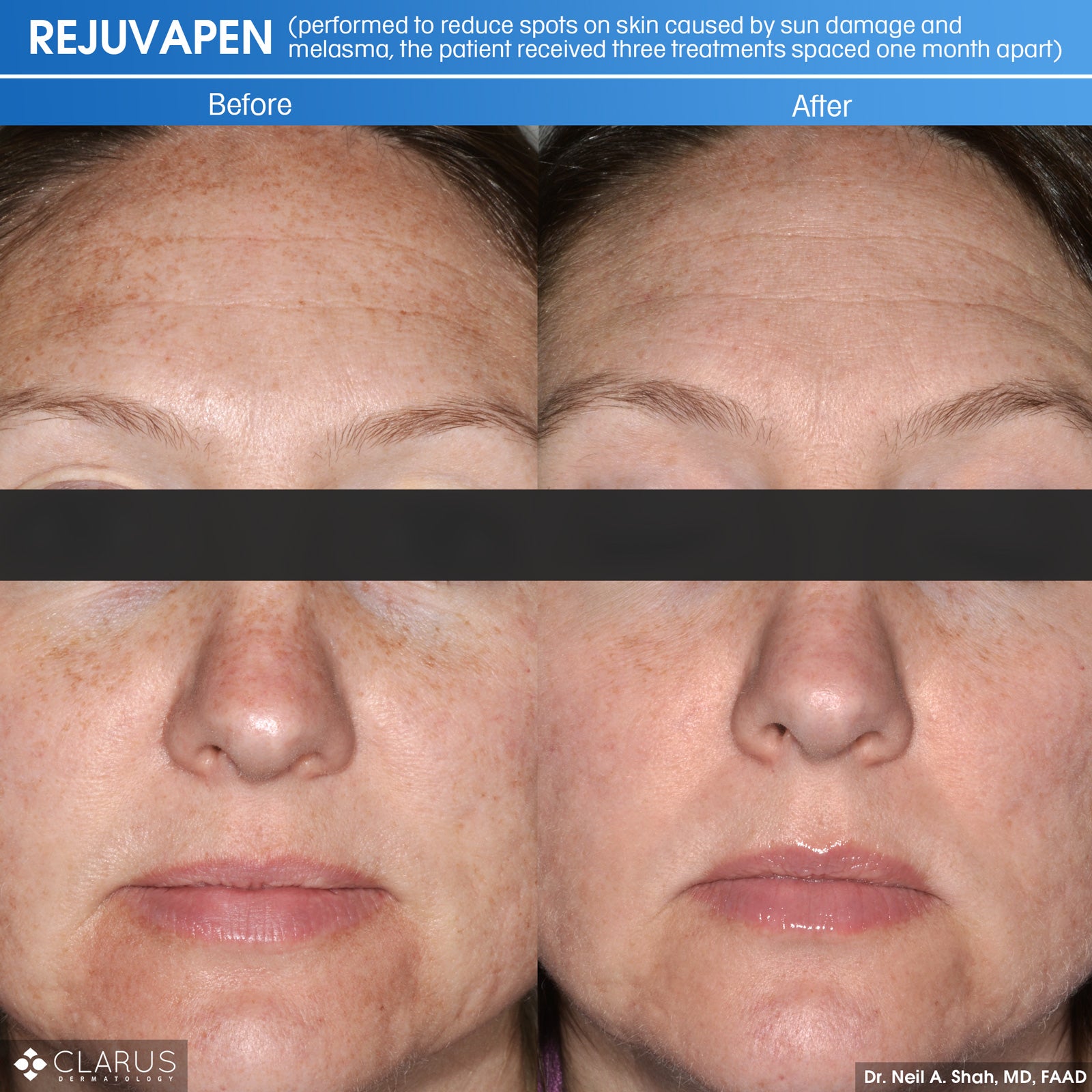 RF Microneedling + 10 FREE Units of Tox with Emily