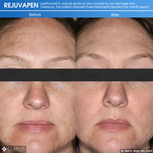 Load image into Gallery viewer, Microneedling Package – 3 Sessions (face &amp; neck) + 3 VAMP- 50% OFF
