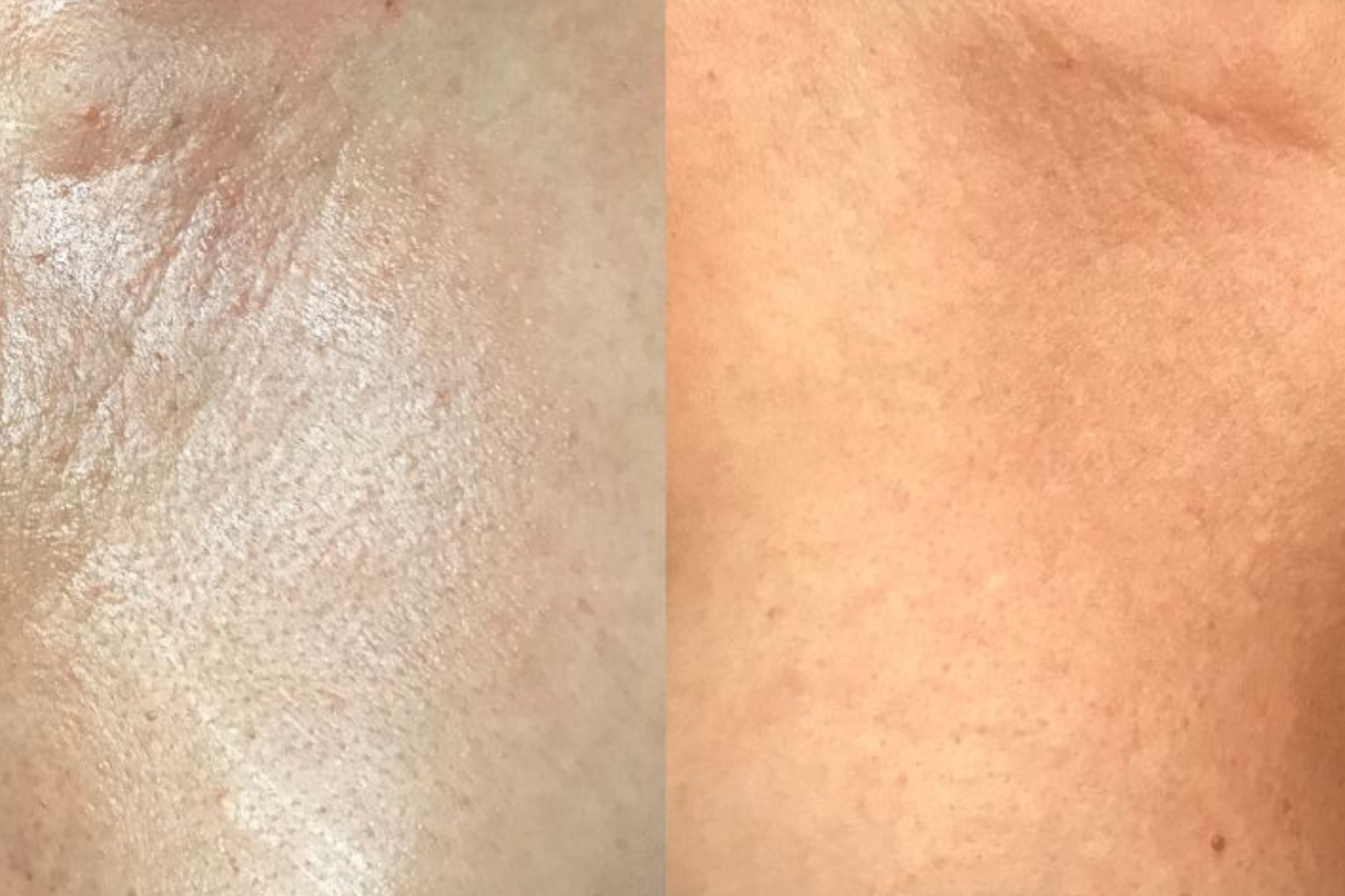 Chest Rejuvenation w/ Filler