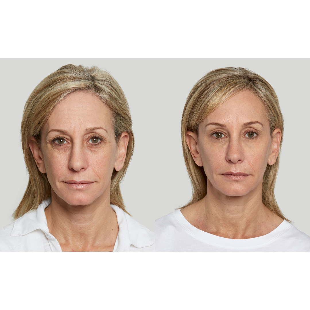 Sculptra® – Restore Volume, Smooth Lines & Rebuild Collagen Naturally