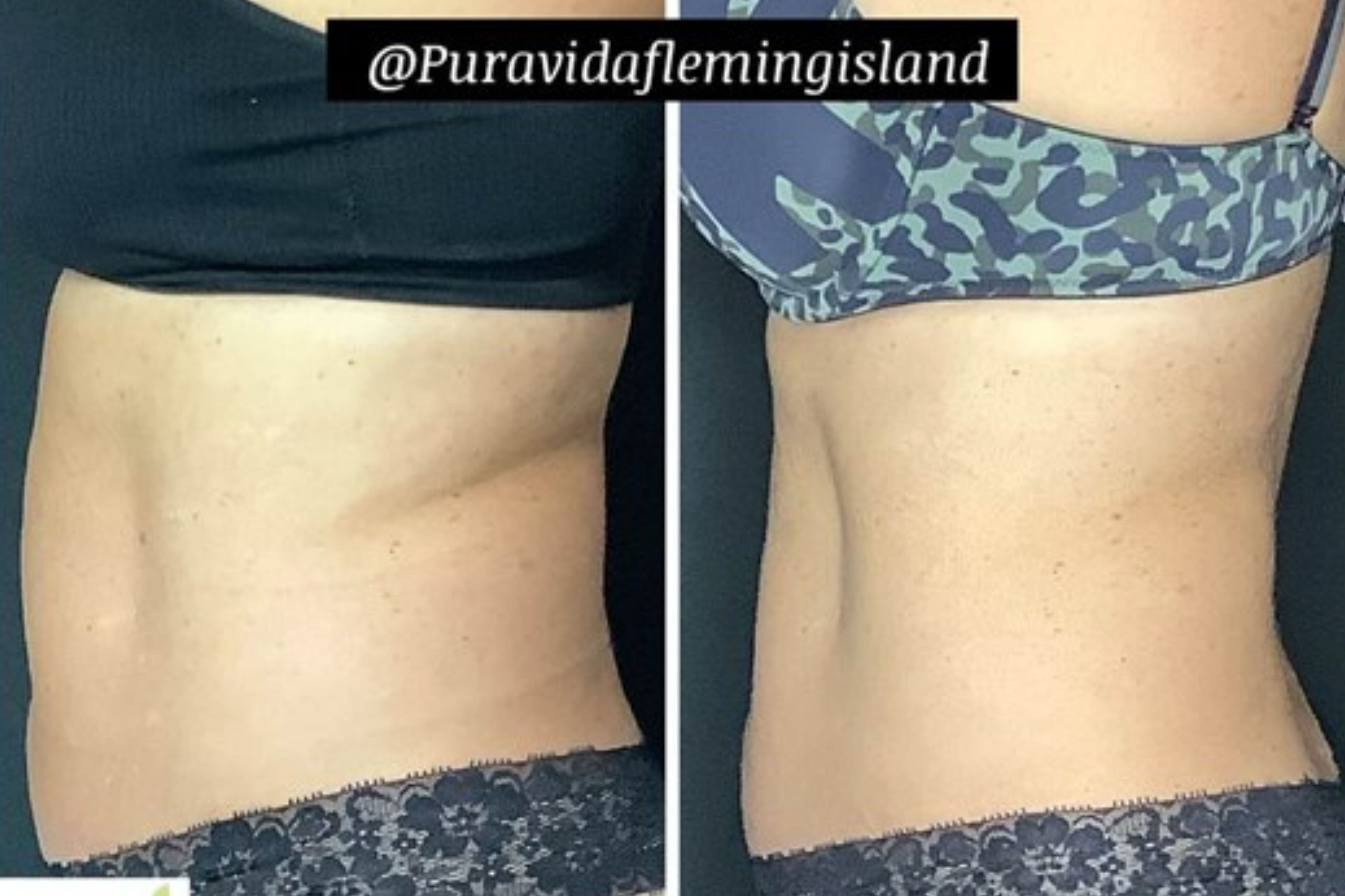 Emsculpt Neo® – Sculpt, Tone & Transform Your Body