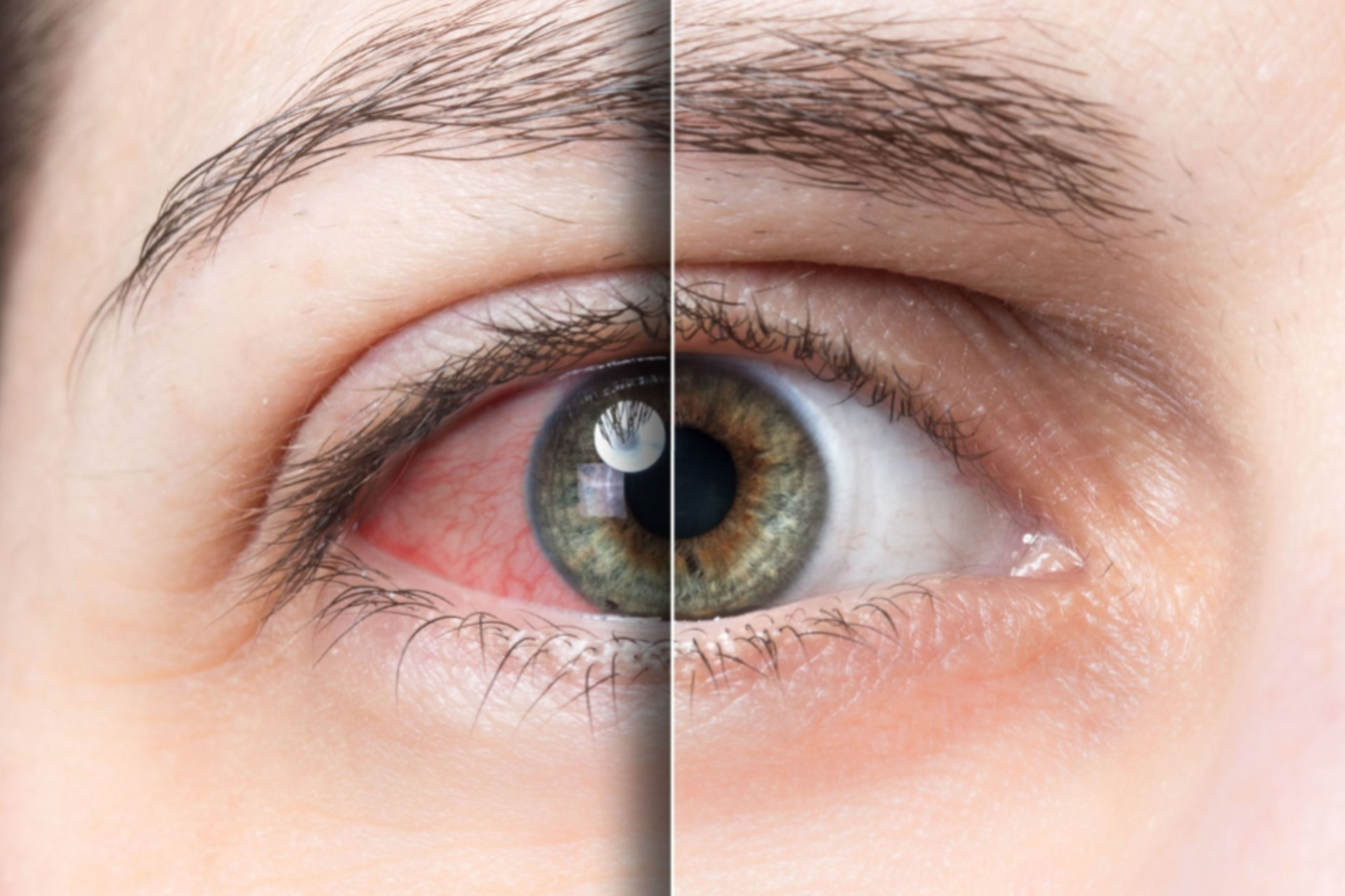 Dry Eye Bundle