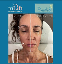 Load image into Gallery viewer, TriLift Non-Surgical Facelift package- 50% OFF
