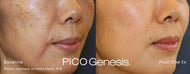 PicoGenesis™ Package – Precision Brightening & Total Skin Renewal