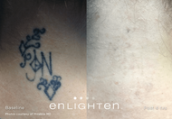 Tattoo Removal – 8 Session Transformation Package | 30% Savings