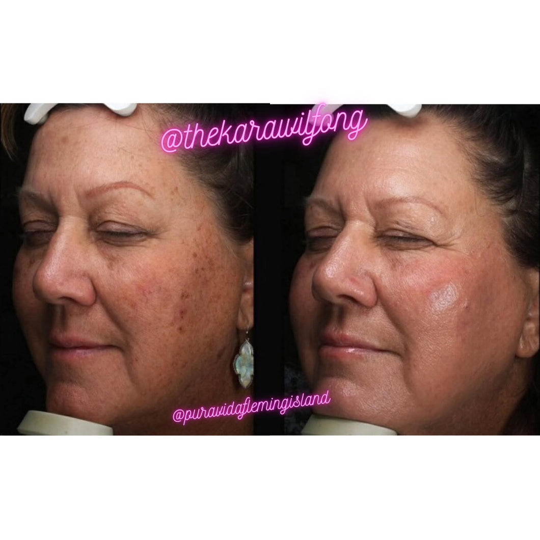 IPL Photofacial – Reveal Your Radiance