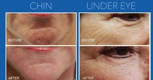 RF Microneedling + 10 FREE Units of Tox with Emily
