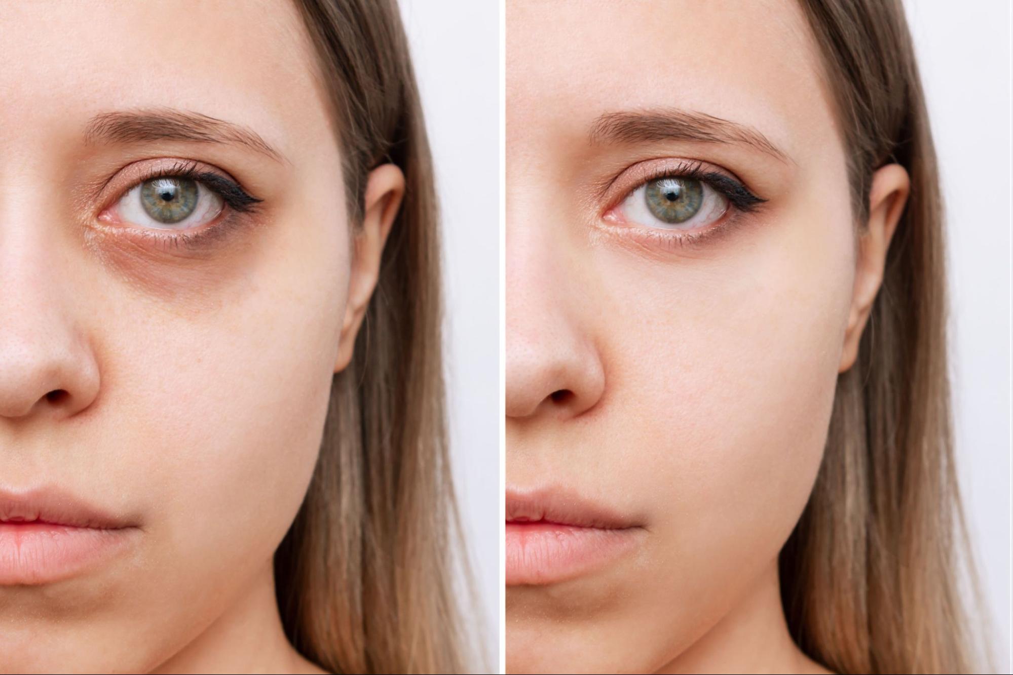 Under-Eye Rejuvenation Package- 25% OFF
