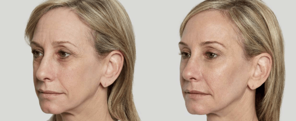 Dermal Fillers