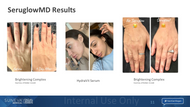 SeruGlow Micro-Channeling Consult