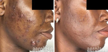 Load image into Gallery viewer, Laser Skin Rejuvenation (Acupulse, IPL, and Aerolase)
