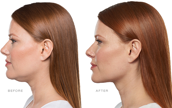 Double Chin Fat Reduction
