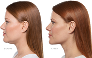 Double Chin Fat Reduction