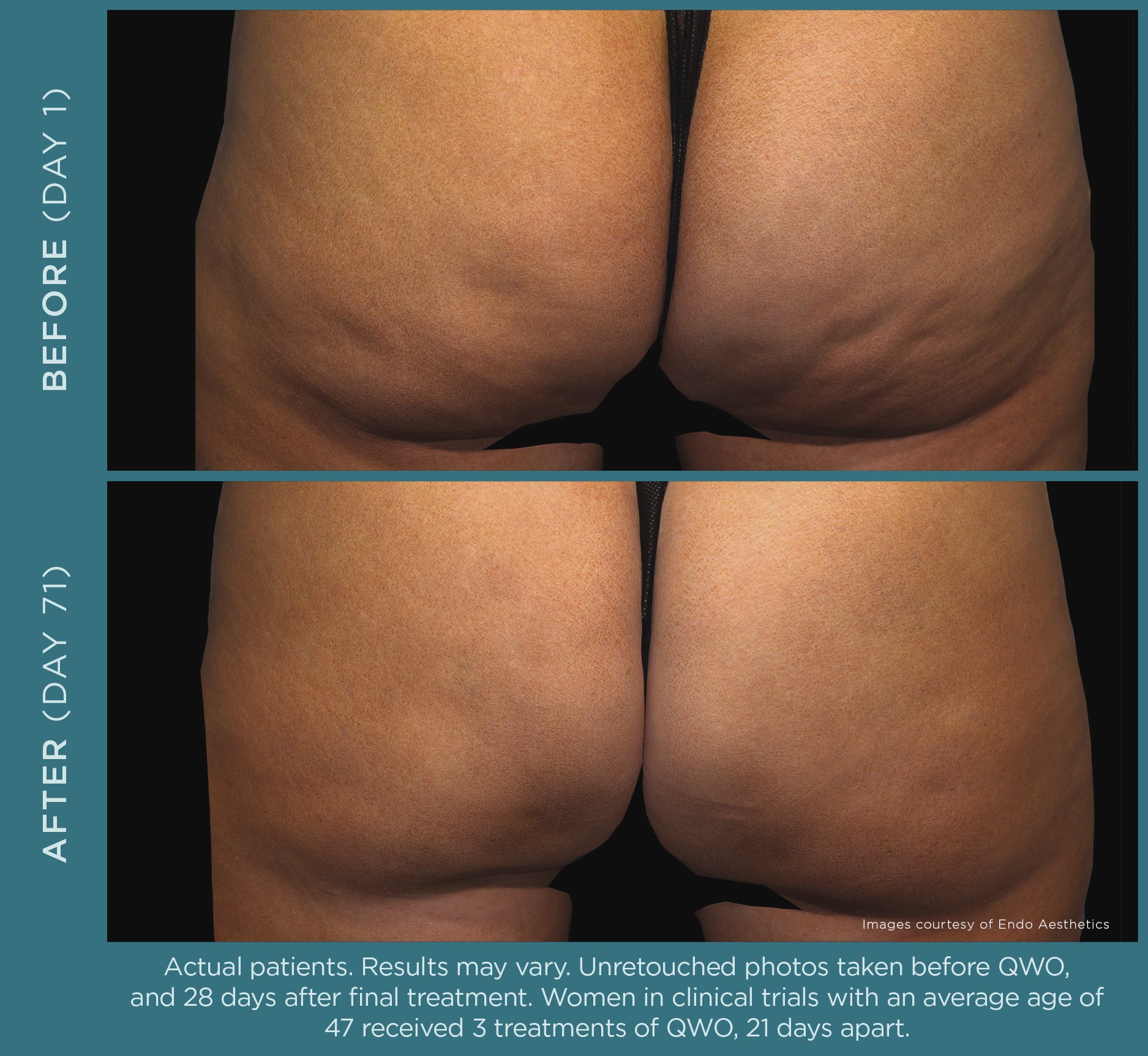 Non-Surgical Mommy Makeover Bundles
